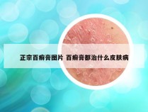 正宗百癣膏图片 百癣膏都治什么皮肤病