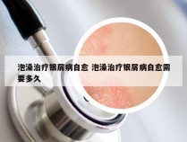 泡澡治疗银屑病自愈 泡澡治疗银屑病自愈需要多久