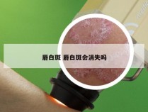 唇白斑 唇白斑会消失吗