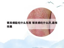 银肖病能吃什么东西 银肖病吃什么药,最有效果