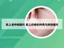 脸上各种癣图片 脸上的癣的种类与辨别图片