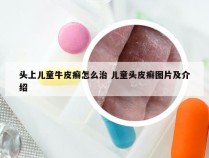 头上儿童牛皮癣怎么治 儿童头皮癣图片及介绍