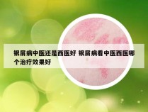 银屑病中医还是西医好 银屑病看中医西医哪个治疗效果好