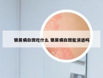 银屑病白斑吃什么 银屑病白斑能消退吗