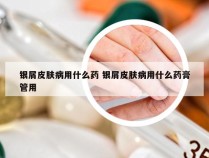 银屑皮肤病用什么药 银屑皮肤病用什么药膏管用