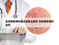 急性银屑病早期点状能治愈吗 急性银屑病好治吗