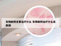 生物制剂主要治疗什么 生物制剂治疗什么皮肤病