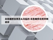 白色糠疹白斑怎么引起的 白色糠疹白斑早期症状