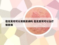 他克莫司可以用银屑病吗 他克莫司可以治疗银屑病