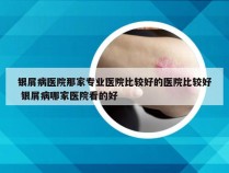 银屑病医院那家专业医院比较好的医院比较好 银屑病哪家医院看的好