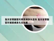 复方甘草酸苷片银屑病多久见效 复方甘草酸苷片银屑病多久见效果