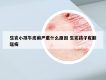 生完小孩牛皮癣严重什么原因 生完孩子皮肤起癣