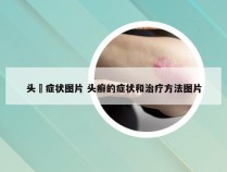 头廯症状图片 头癣的症状和治疗方法图片