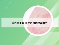 治白斑土方 治疗白斑的民间偏方