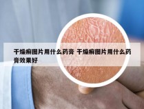 干燥癣图片用什么药膏 干燥癣图片用什么药膏效果好