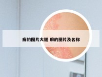 癣的图片大腿 癣的图片及名称