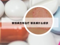 银悄病怎样治疗 银肖病什么症状