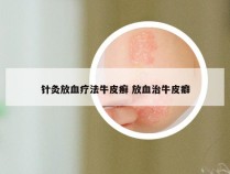 针灸放血疗法牛皮癣 放血治牛皮癖