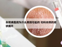 白斑病是因为什么原因引起的 妇科白斑的症状图片