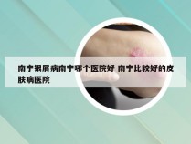 南宁银屑病南宁哪个医院好 南宁比较好的皮肤病医院