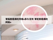 掌跖脓疱病吃阿维a多久见效 掌跎脓疱病吃阿维a