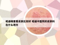 昭通哪里看皮肤比较好 昭通中医院的皮肤科在什么地方