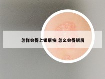 怎样会得上银屑病 怎么会得银屑