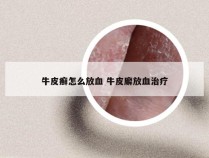 牛皮癣怎么放血 牛皮廨放血治疗