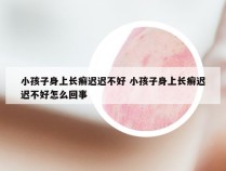 小孩子身上长癣迟迟不好 小孩子身上长癣迟迟不好怎么回事