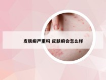 皮肤癣严重吗 皮肤癣会怎么样