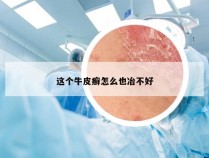 这个牛皮癣怎么也冶不好