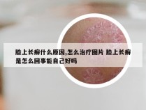 脸上长癣什么原因,怎么治疗图片 脸上长癣是怎么回事能自己好吗