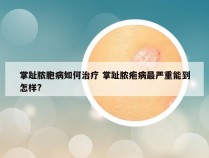 掌趾脓胞病如何治疗 掌趾脓疱病最严重能到怎样?