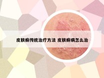 皮肤癣传统治疗方法 皮肤癣病怎么治