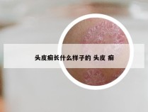 头皮癣长什么样子的 头皮 癣