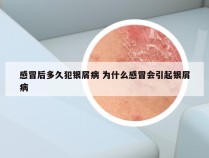 感冒后多久犯银屑病 为什么感冒会引起银屑病