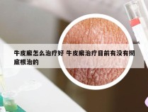 牛皮廨怎么治疗好 牛皮廨治疗目前有没有彻底根治的