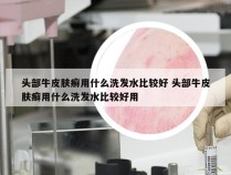 头部牛皮肤癣用什么洗发水比较好 头部牛皮肤癣用什么洗发水比较好用