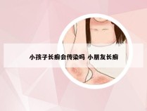 小孩子长癣会传染吗 小朋友长癣