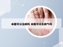 米醋可以治癣吗 米醋可以去脚气吗