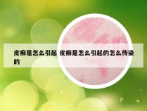 皮癣是怎么引起 皮癣是怎么引起的怎么传染的