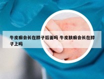 牛皮癣会长在脖子后面吗 牛皮肤癣会长在脖子上吗