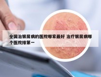 全国治银屑病的医院哪家最好 治疗银屑病哪个医院排第一