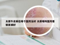 太原牛皮癣在哪个医院治好 太原哪所医院看银屑病好