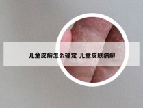 儿童皮癣怎么确定 儿童皮肤病癣