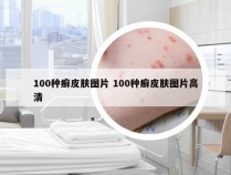 100种癣皮肤图片 100种癣皮肤图片高清