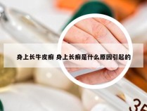 身上长牛皮癣 身上长癣是什么原因引起的