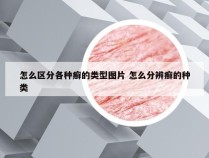 怎么区分各种癣的类型图片 怎么分辨癣的种类