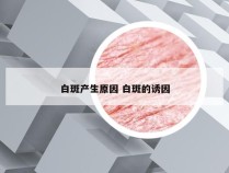 白斑产生原因 白斑的诱因