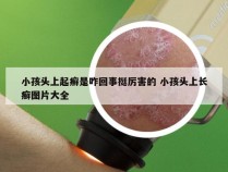 小孩头上起癣是咋回事挺厉害的 小孩头上长癣图片大全